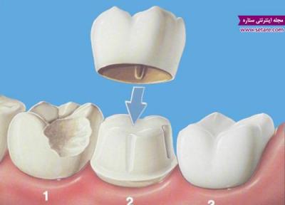 روکش دندان و هر آنچه که درباره آن باید بدانید