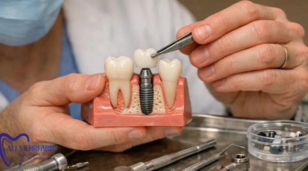 ایمپلنت دیجیتال برای چه کسانی مناسب است؟ آنالیز تخصصی مزایا و کاندیداهای ایده آل