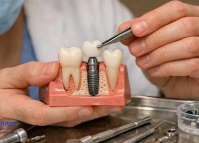 ایمپلنت دیجیتال برای چه کسانی مناسب است؟ آنالیز تخصصی مزایا و کاندیداهای ایده آل